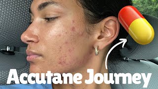 Starting my ACCUTANE journey Isotretinoin  Accutane side effects amp process [upl. by Reddin]