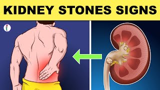 Kidney Stones Symptoms  All You Need to Know [upl. by Ecallaw]