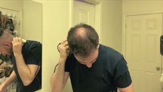 BALDING IN MY 20s  Shaving My Head And Embracing Going Bald LIVE [upl. by Weasner]