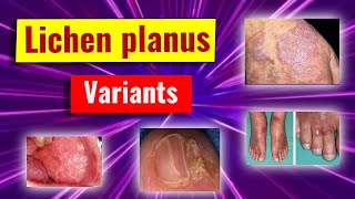 Clinical variants of lichen planus [upl. by Eifos]