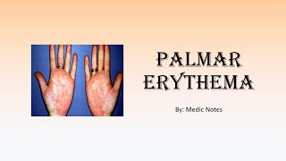 Palmar erythema causes and pathophysiology [upl. by Philipp300]