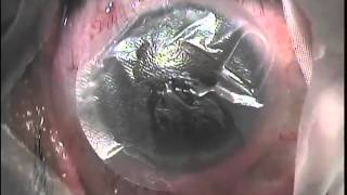 John Hovanesian AmbioLens Amniotic Membrane Transplant Placement with Contact Lens [upl. by Jeromy877]