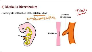 USMLE ACE Video 157 Common Gastrointestinal Disorders [upl. by Lower]