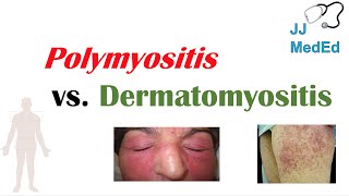 Idiopathic Inflammatory Myopathies  Polymyositis vs Dermatomyositis [upl. by Aneek]