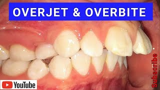 Overjet amp Overbite  Causes amp Treatment Using Braces amp Invisalign [upl. by Hsot]