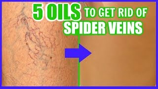 HOW TO GET RID OF SPIDER VEINS WITH ESSENTIAL OILS │ TOP 5 OILS TO FADE AND ERASE VARICOSE VEINS [upl. by Bishop94]