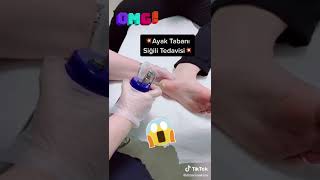 Ayak Tabanı Siğil Tedavisi 🦶🏻Dermatolog Doç Dr Berna Aksoy [upl. by Nivahb367]