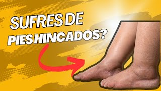 Pies Hinchados Como Aliviarlos con Remedios Naturales [upl. by Aserat]