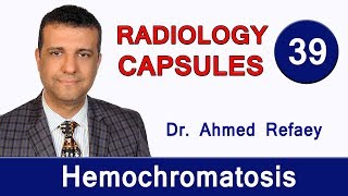 Capsule 39  Hemochromatosis [upl. by Nepean9]