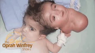 The 2Headed Baby Miracle  The Oprah Winfrey Show  Oprah Winfrey Network [upl. by Terrag]