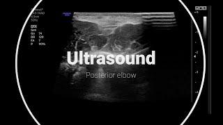 Olecranon bursitis and triceps insertional calcific enthesopathy thereportingroom [upl. by Iosep892]