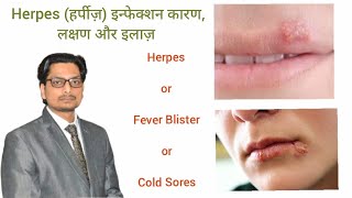 Herpes Infection of Skin  हर्पीज़ का कारण लक्षण और इलाज़ Herpes Symptoms Causes Treatment herpes [upl. by Ennyroc522]