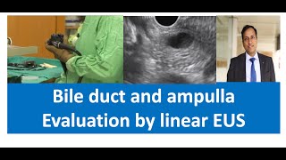 Linear EUS anatomy Evaluation of Common bile duct and ampulla  Dr Vikas Singla [upl. by Eimirej]