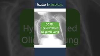 📸 XRay Insights Hyperinflated Lungs Radiology LungHealth usmle [upl. by Hamner]