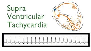 Supraventricular Tachycardia [upl. by Neeloc]