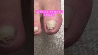 Help problem toes with acrylic nail repair acrylictoes pedicure acrylicnails diypedicure nails [upl. by Hobbs31]