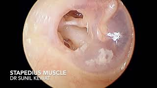 Glimpses of Stapedius Muscle and Stapes Bone  Otoendoscopy  Dr Sunil Kewat [upl. by Gauntlett]