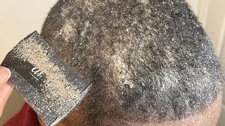 Close up Scalp Cleanse ASMR We Scratch You Relax [upl. by Rahmann662]