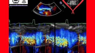 Severe Aortic Regurgitation [upl. by Margeaux]