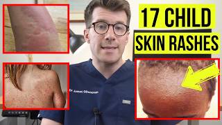 Identifying SKIN RASHES in BABIES and CHILDREN  DOCTOR explains 17 COMMON SKIN CONDITIONS [upl. by Aisatna846]