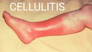 Cellulitis Skin InfectionCellulitisCauses SymptomsDiagnosisTreatmentPrevention Complications [upl. by Eecyal]