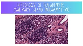 Histology of Sialadenitis Salivary Gland Inflammation [upl. by Giusto]