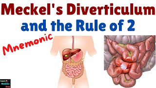 Meckels Diverticulum and the Rule of 2 – Meckels Diverticulum Explained [upl. by Dian206]