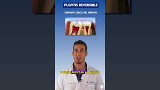 Estas son las CAUSAS de la PULPITIS reversible o INFLAMACIÓN del NERVIO DENTAL [upl. by Shiroma]