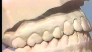 Occlusal Examination of Correctly Articulated Casts [upl. by Grewitz]