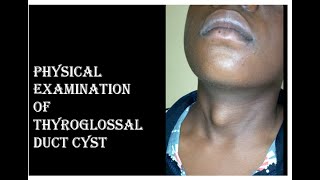 THYROGLOSSAL DUCT CYST EXAMINATION [upl. by Akitnahs]