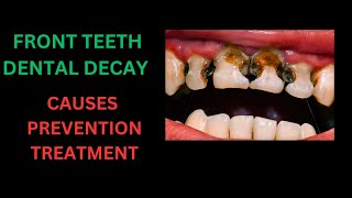 TEETH DECAY IN FRONT TEETH  EVIDENCE BASED DENTAL DECAY MANAGEMENT IN FRONT TEETH [upl. by Eimmit]