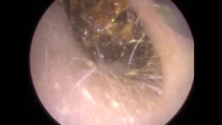 205 Ear Wax Teased and Wriggled out of Narrow Ear Canal  Mr Neel Raithatha THC [upl. by Trevlac]