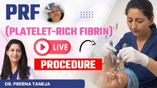 PRFPlateletrich Fibrin Live Procedure  PRF for Glowing Skin  Clinic Eximus [upl. by Moyna290]