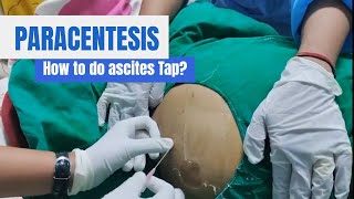 Paracentesis Procedure Ascites Tap in detail [upl. by Itra]