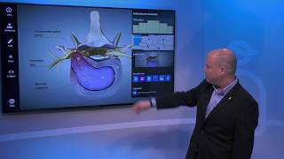 Understanding Epidural Injection [upl. by Kurland]