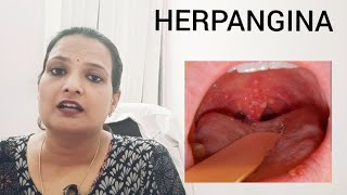 HERPANGINA throat ulcers in kids with high fever precautions and treatment [upl. by Fiedling]