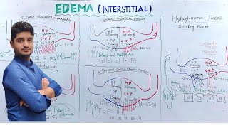 Interstitial Edema Pathology  Edema part 3 [upl. by Einaeg737]