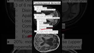 Frontotemporal dementia [upl. by Millar401]