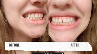 Dr Song Teeth Whitening Review Before and After 1 use [upl. by Ardnuaek]