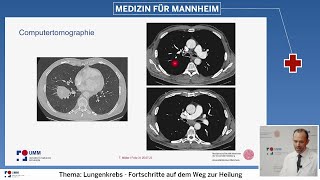 Vom Röntgenbild bis zur Therapie  moderne Diagnostik bei Lungenkrebs [upl. by Eloci482]