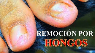 REMOCION DE UÑAS INFECTADAS POR HONGOS ONICOMICOSIS [upl. by Dodwell]