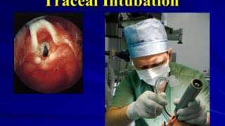 03 Tracheal Intubation [upl. by Joyann]