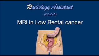 MRI in Rectal Cancer  Lecture 2  tumor in the low rectum [upl. by Afihtan]