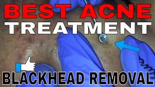 BEST ACNE TREATMENT with BLACKHEAD REMOVAL PART1 [upl. by Aizek137]