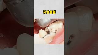 dentistry tooth filling shenzhen shorts [upl. by Marilla]