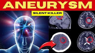 ANEURYSMS The Silent Killer [upl. by Shyamal]