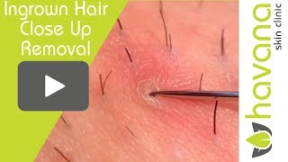 In Grown Hair Removal Close Up Recap [upl. by Atiekan]