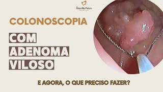 Colonoscopia com adenoma VILOSO [upl. by Tavis]