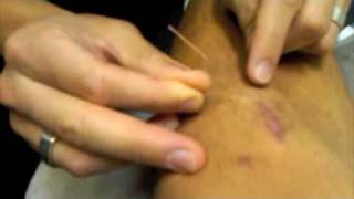 Scar tissue mobilization using myofascial needling [upl. by Syla]