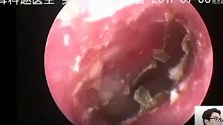 Earwax Removal Extraction Carefully Extract Mold Earwax清理霉菌需要特别小心 外耳道挖耳屎清理耳垢 [upl. by Jeroma]